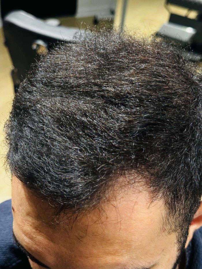 Antes do procedimento 1